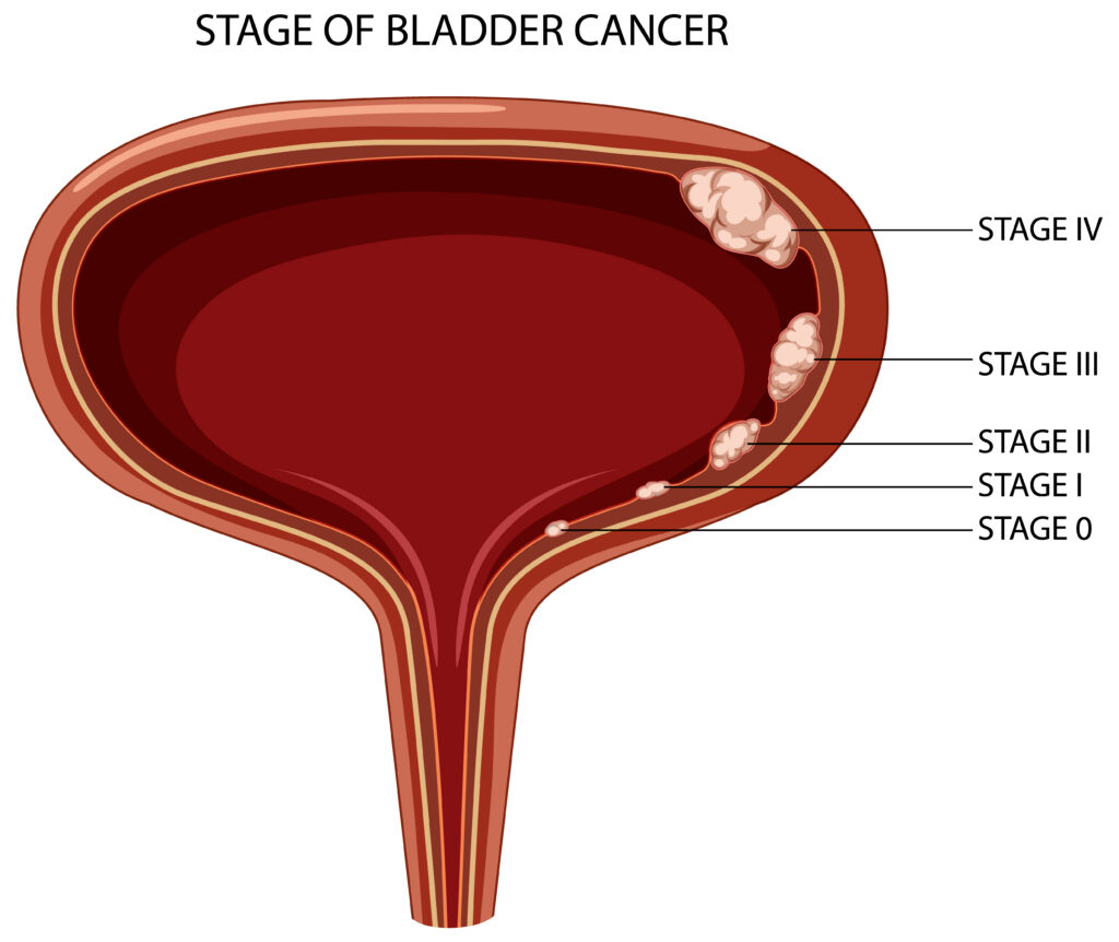 Diagram showing stages of bladder cancer, explained by a Urologist In Vadodara.